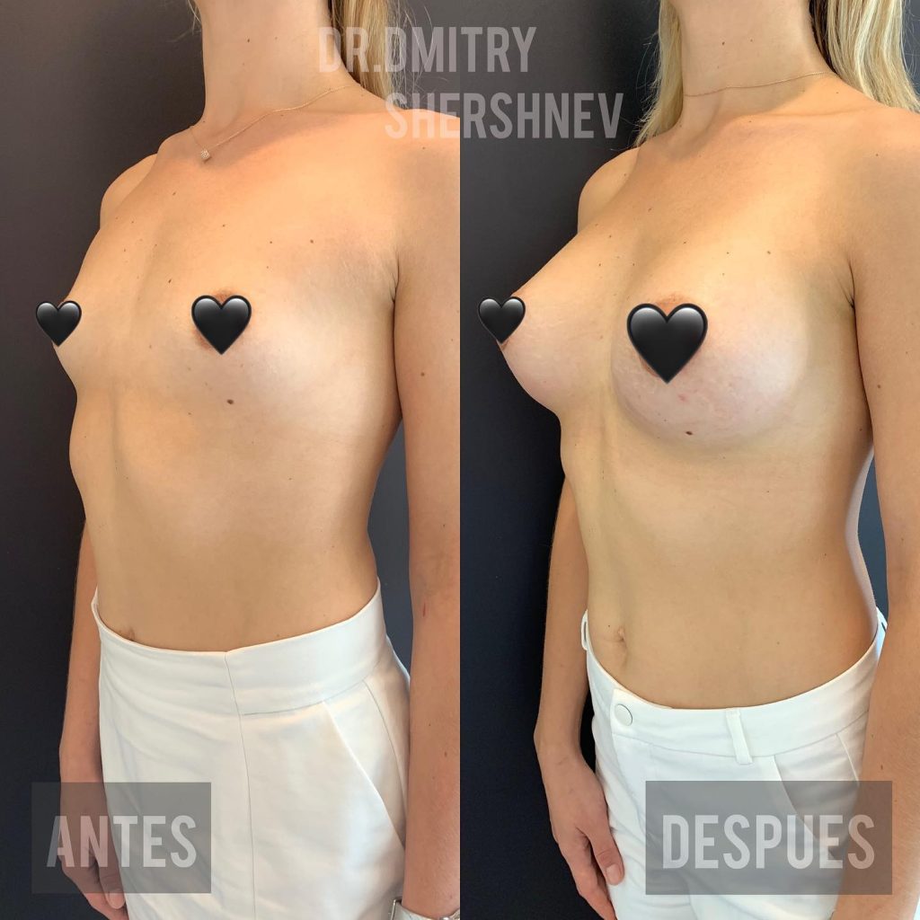 mama tuberosa antes y despues