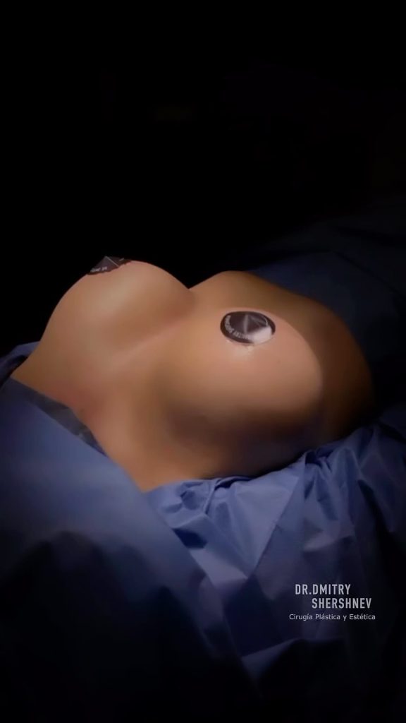 Mastopexia Lipofiling mamario