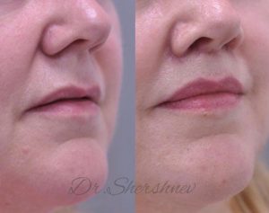 Queiloplastia