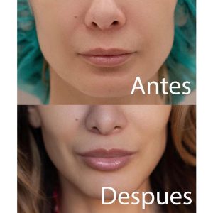 Queiloplastia2