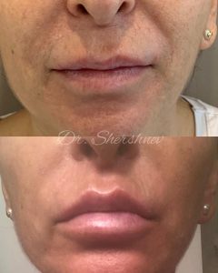 Queiloplastia3